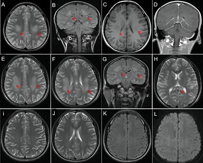 Case Report: Early-Onset Charcot-Marie-Tooth 2N With Reversible White Matter Lesions Repeatedly Mimicked Stroke or Encephalitis